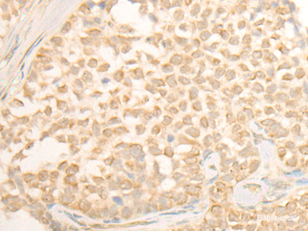 Immunohistochemistry of paraffin-embedded Human ovarian cancer tissue  using CYP4X1 Polyclonal Antibody at dilution of 1:40(×200)