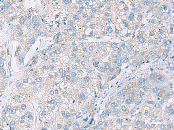 Immunohistochemistry of paraffin-embedded Human liver cancer tissue  using DACT3 Polyclonal Antibody at dilution of 1:55(×200)