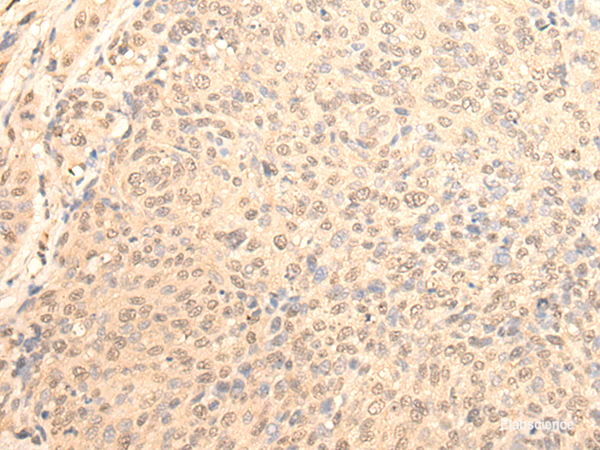 Immunohistochemistry of paraffin-embedded Human cervical cancer tissue  using DAZ1 Polyclonal Antibody at dilution of 1:70(×200)
