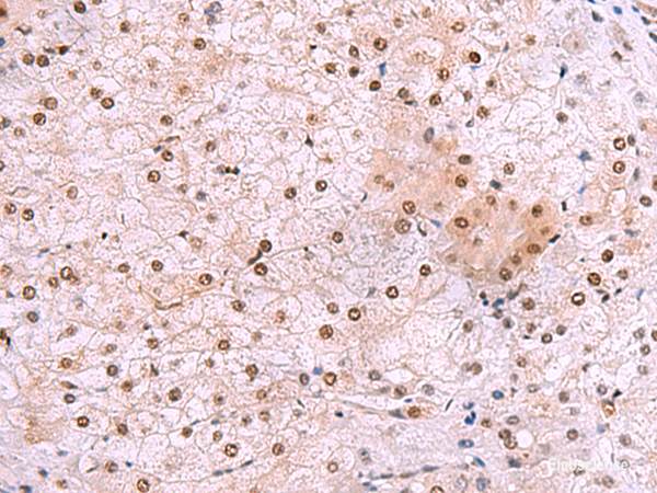 Immunohistochemistry of paraffin-embedded Human liver cancer tissue  using DDI2 Polyclonal Antibody at dilution of 1:50(×200)
