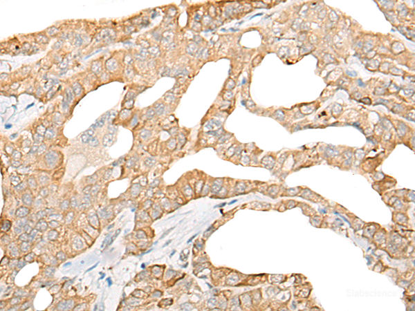 Immunohistochemistry of paraffin-embedded Human thyroid cancer tissue  using DDX24 Polyclonal Antibody at dilution of 1:35(×200)