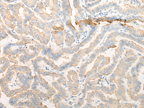 Immunohistochemistry of paraffin-embedded Human thyroid cancer tissue  using CELA3A Polyclonal Antibody at dilution of 1:25(×200)