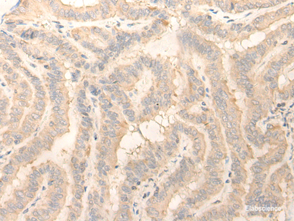 Immunohistochemistry of paraffin-embedded Human thyroid cancer tissue  using ERP27 Polyclonal Antibody at dilution of 1:25(×200)