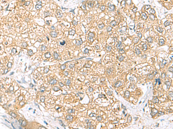 Immunohistochemistry of paraffin-embedded Human liver cancer tissue  using SH3GL2 Polyclonal Antibody at dilution of 1:45(×200)