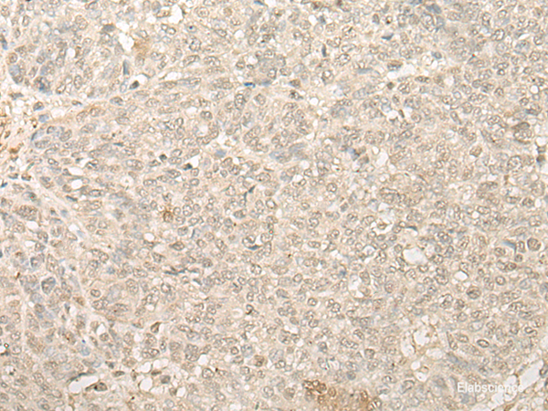 Immunohistochemistry of paraffin-embedded Human ovarian cancer tissue  using FYTTD1 Polyclonal Antibody at dilution of 1:25(×200)