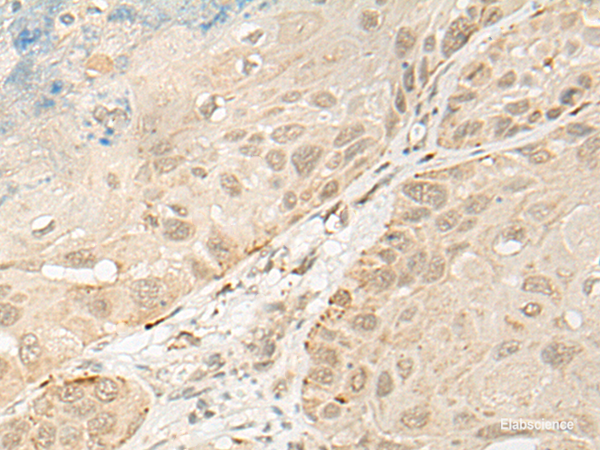 Immunohistochemistry of paraffin-embedded Human esophagus cancer tissue  using OTX1 Polyclonal Antibody at dilution of 1:30(×200)