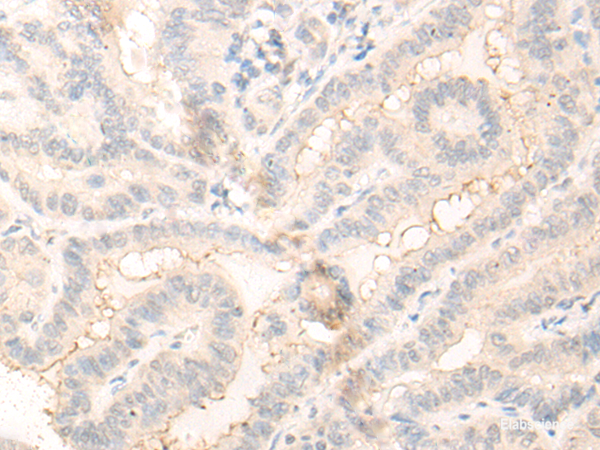 Immunohistochemistry of paraffin-embedded Human thyroid cancer tissue  using RADIL Polyclonal Antibody at dilution of 1:30(×200)