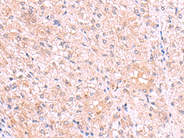 Immunohistochemistry of paraffin-embedded Human liver cancer tissue  using PISD Polyclonal Antibody at dilution of 1:80(×200)