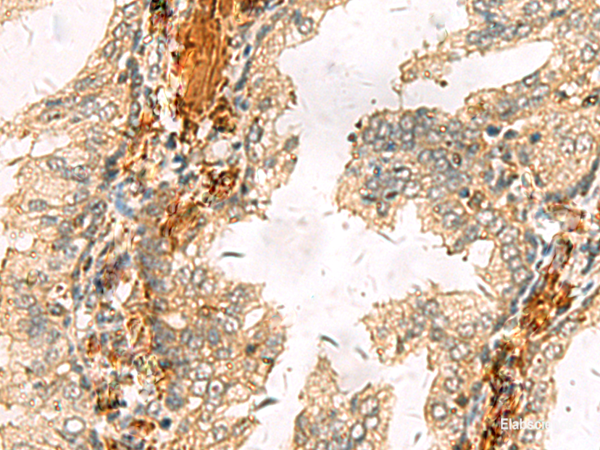 Immunohistochemistry of paraffin-embedded Human prost at e cancer tissue  using ACTC1 Polyclonal Antibody at dilution of 1:65(×200)