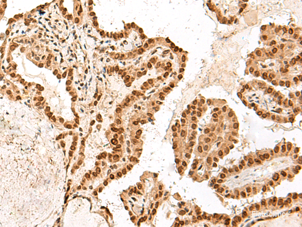 Immunohistochemistry of paraffin-embedded Human thyroid cancer tissue  using ARMC8 Polyclonal Antibody at dilution of 1:60(×200)