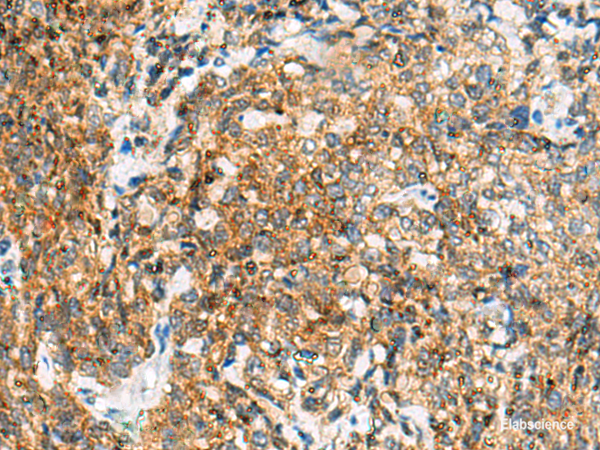 Immunohistochemistry of paraffin-embedded Human cervical cancer tissue  using TUFT1 Polyclonal Antibody at dilution of 1:120(×200)