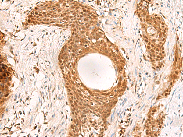 Immunohistochemistry of paraffin-embedded Human esophagus cancer tissue  using RMND5B Polyclonal Antibody at dilution of 1:50(×200)