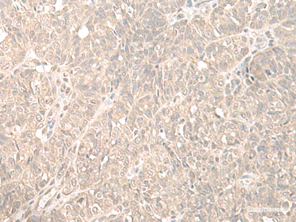 Immunohistochemistry of paraffin-embedded Human ovarian cancer tissue  using HENMT1 Polyclonal Antibody at dilution of 1:35(×200)
