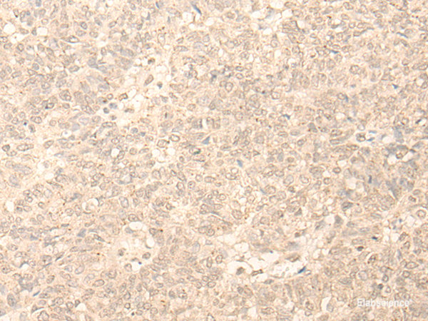Immunohistochemistry of paraffin-embedded Human ovarian cancer tissue  using PLEKHA1 Polyclonal Antibody at dilution of 1:30(×200)