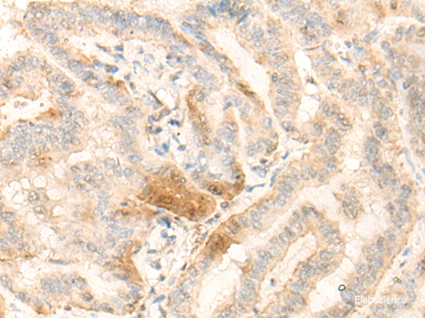 Immunohistochemistry of paraffin-embedded Human thyroid cancer tissue  using BZW2 Polyclonal Antibody at dilution of 1:25(×200)