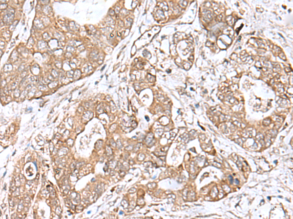 Immunohistochemistry of paraffin-embedded Human gastric cancer tissue  using TEAD2 Polyclonal Antibody at dilution of 1:60(×200)