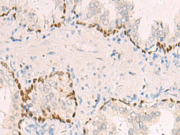 Immunohistochemistry of paraffin-embedded Human prost at e cancer tissue  using TP63 Polyclonal Antibody at dilution of 1:40(×200)