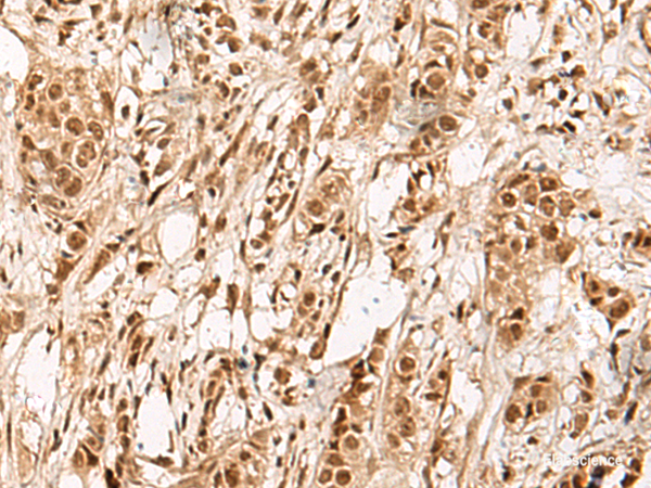 Immunohistochemistry of paraffin-embedded Human breast cancer tissue  using ZBTB43 Polyclonal Antibody at dilution of 1:90(×200)