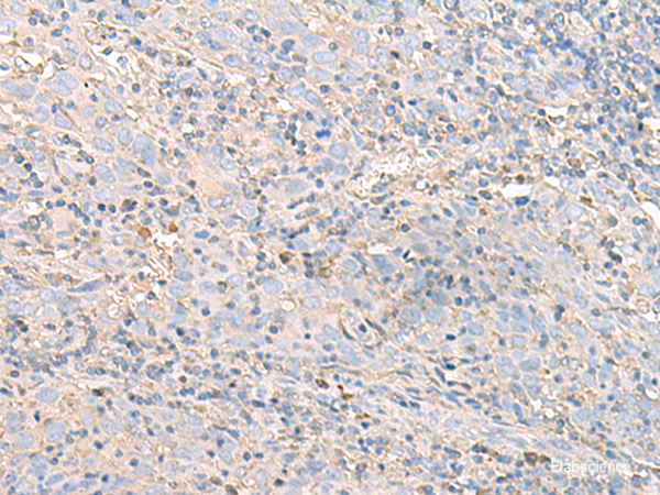 Immunohistochemistry of paraffin-embedded Human cervical cancer tissue  using IGHA1 Polyclonal Antibody at dilution of 1:50(×200)