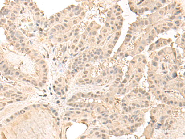 Immunohistochemistry of paraffin-embedded Human thyroid cancer tissue  using ZGPAT Polyclonal Antibody at dilution of 1:35(×200)