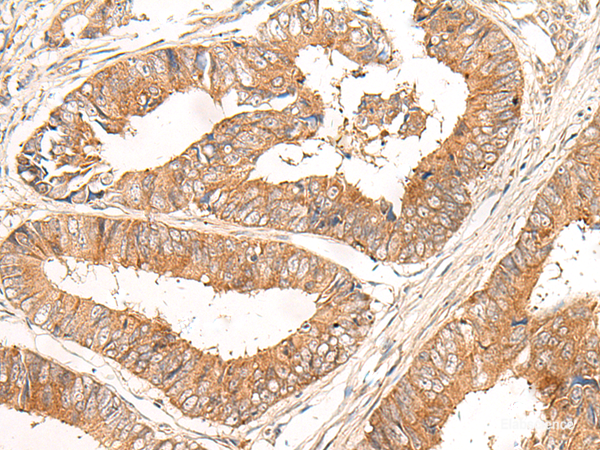 Immunohistochemistry of paraffin-embedded Human colorectal cancer tissue  using CORO2A Polyclonal Antibody at dilution of 1:30(×200)