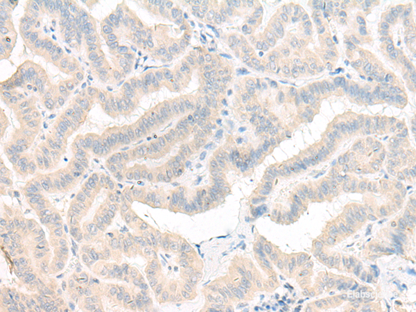 Immunohistochemistry of paraffin-embedded Human thyroid cancer tissue  using AOAH Polyclonal Antibody at dilution of 1:25(×200)