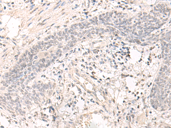 Immunohistochemistry of paraffin-embedded Human esophagus cancer tissue  using SAP130 Polyclonal Antibody at dilution of 1:35(×200)