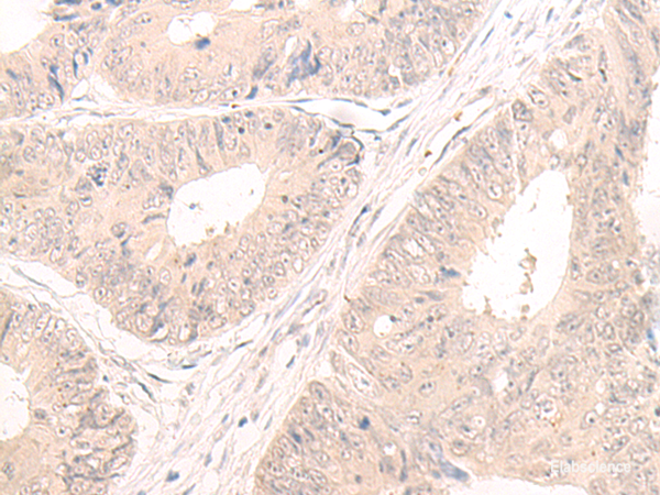 Immunohistochemistry of paraffin-embedded Human colorectal cancer tissue  using LCMT2 Polyclonal Antibody at dilution of 1:55(×200)