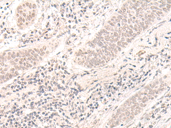 Immunohistochemistry of paraffin-embedded Human esophagus cancer tissue  using ZBED1 Polyclonal Antibody at dilution of 1:40(×200)