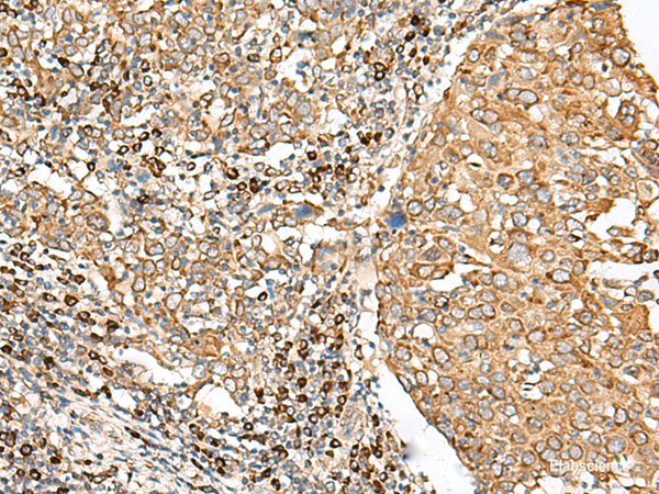 Immunohistochemistry of paraffin-embedded Human cervical cancer tissue  using STT3A Polyclonal Antibody at dilution of 1:70(×200)