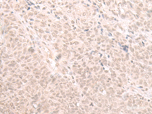 Immunohistochemistry of paraffin-embedded Human ovarian cancer tissue  using HOOK2 Polyclonal Antibody at dilution of 1:30(×200)