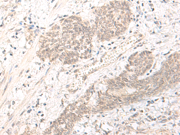 Immunohistochemistry of paraffin-embedded Human esophagus cancer tissue  using PBXIP1 Polyclonal Antibody at dilution of 1:40(×200)