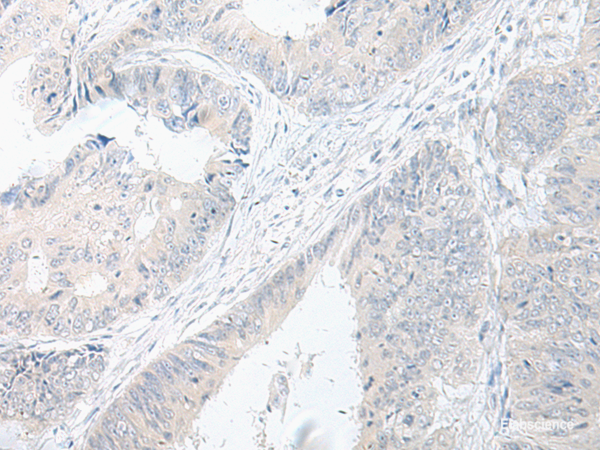 Immunohistochemistry of paraffin-embedded Human colorectal cancer tissue  using GPRASP2 Polyclonal Antibody at dilution of 1:75(×200)