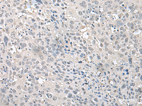 Immunohistochemistry of paraffin-embedded Human cervical cancer tissue  using EPM2A Polyclonal Antibody at dilution of 1:75(×200)