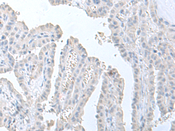 Immunohistochemistry of paraffin-embedded Human thyroid cancer tissue  using STAU2 Polyclonal Antibody at dilution of 1:60(×200)