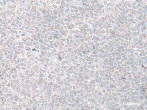 Immunohistochemistry of paraffin-embedded Human ovarian cancer tissue  using C8orf4 Polyclonal Antibody at dilution of 1:70(×200)