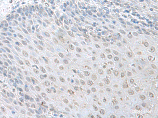 Immunohistochemistry of paraffin-embedded Human esophagus cancer tissue  using LSM10 Polyclonal Antibody at dilution of 1:100(×200)