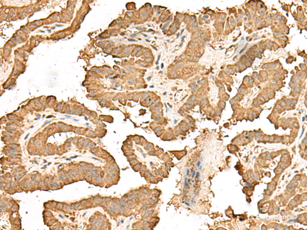 Immunohistochemistry of paraffin-embedded Human thyroid cancer tissue  using RPS25 Polyclonal Antibody at dilution of 1:65(×200)