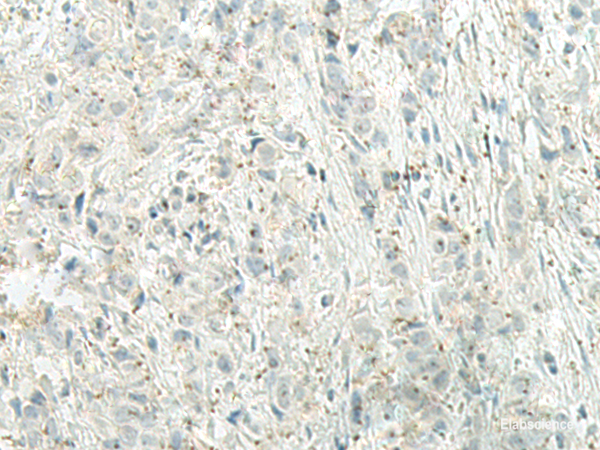 Immunohistochemistry of paraffin-embedded Human breast cancer tissue  using UQCC2 Polyclonal Antibody at dilution of 1:60(×200)