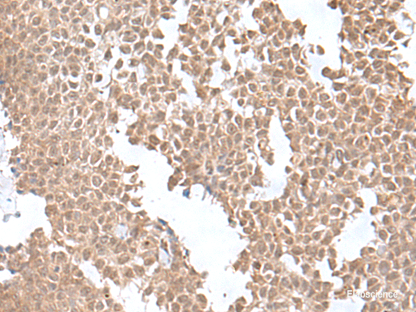 Immunohistochemistry of paraffin-embedded Human ovarian cancer tissue  using SNRNP25 Polyclonal Antibody at dilution of 1:55(×200)