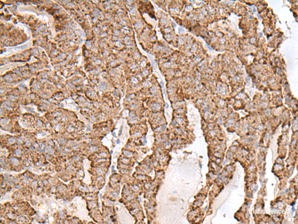 Immunohistochemistry of paraffin-embedded Human thyroid cancer tissue  using AP1S1 Polyclonal Antibody at dilution of 1:65(×200)