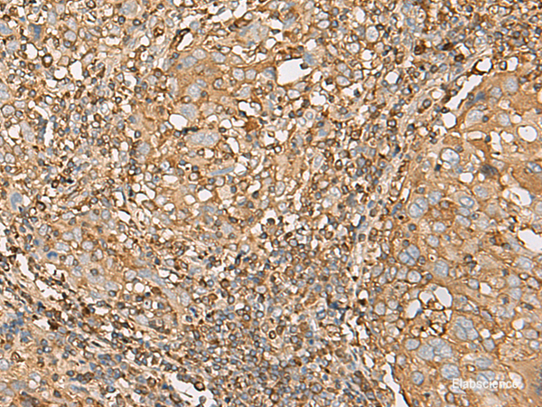 Immunohistochemistry of paraffin-embedded Human cervical cancer tissue  using UBE2A Polyclonal Antibody at dilution of 1:55(×200)