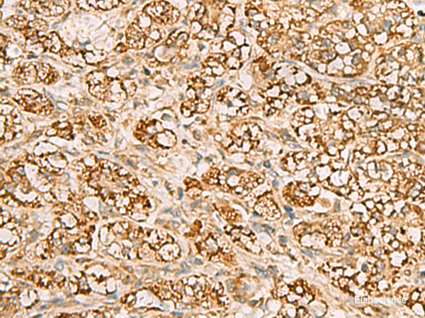 Immunohistochemistry of paraffin-embedded Human liver cancer tissue  using MTAP Polyclonal Antibody at dilution of 1:70(×200)