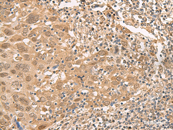 Immunohistochemistry of paraffin-embedded Human cervical cancer tissue  using ISCU Polyclonal Antibody at dilution of 1:45(×200)