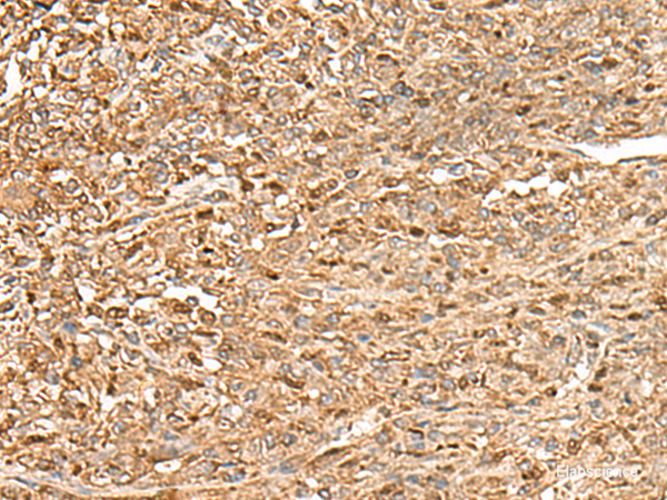Immunohistochemistry of paraffin-embedded Human liver cancer tissue  using ZC3H7A Polyclonal Antibody at dilution of 1:50(×200)