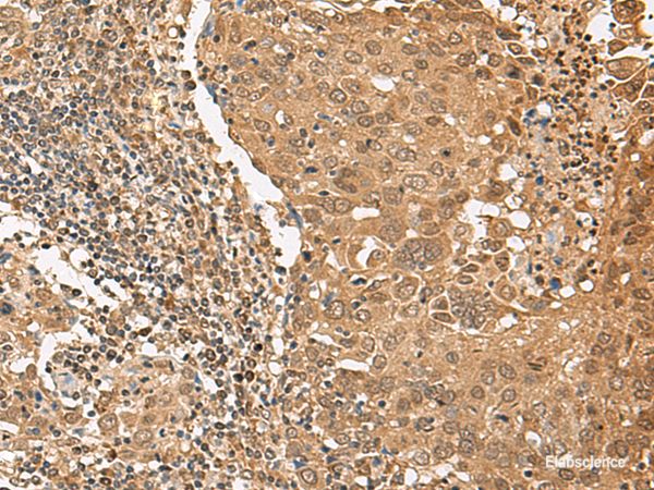 Immunohistochemistry of paraffin-embedded Human cervical cancer tissue  using TIPRL Polyclonal Antibody at dilution of 1:65(×200)