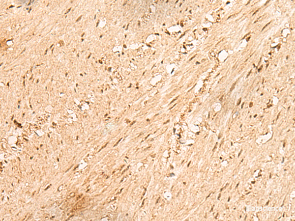 Immunohistochemistry of paraffin-embedded Human colorectal cancer tissue  using JPT2 Polyclonal Antibody at dilution of 1:80(×200)