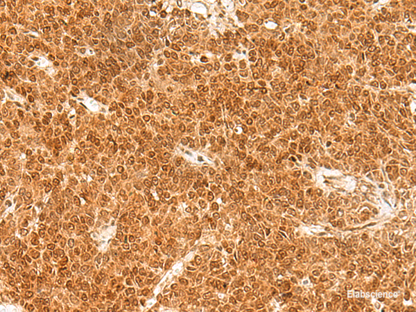Immunohistochemistry of paraffin-embedded Human ovarian cancer tissue  using TOR1A Polyclonal Antibody at dilution of 1:30(×200)