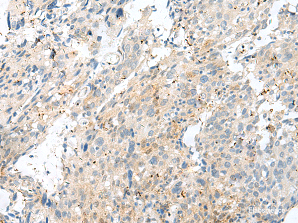 Immunohistochemistry of paraffin-embedded Human cervical cancer tissue  using NXNL1 Polyclonal Antibody at dilution of 1:45(×200)