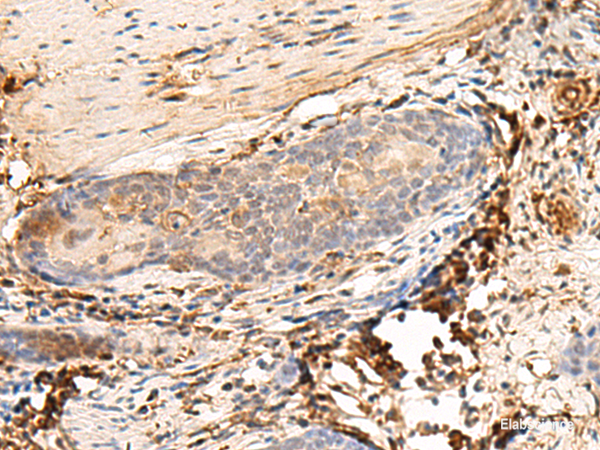 Immunohistochemistry of paraffin-embedded Human esophagus cancer tissue  using HLA-DQB1 Polyclonal Antibody at dilution of 1:30(×200)